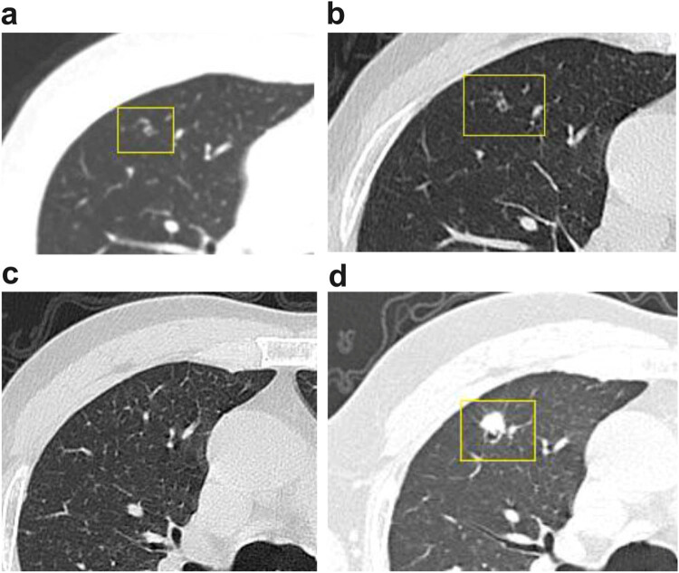 Solitary pulmonary metastasis with cystic airspaces in colon cancer: A rare case report.