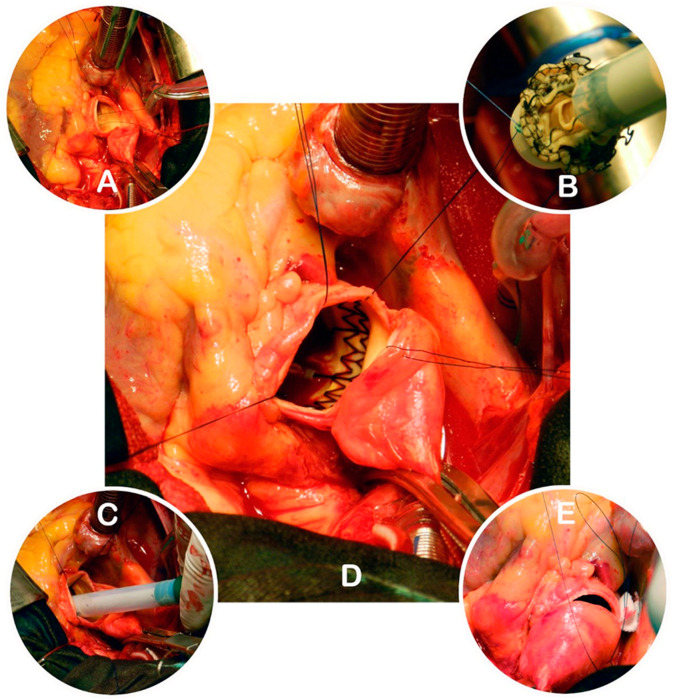 Comparison of Surgical Treatment Outcomes in Patients with Symptomatic Severe Aortic Valve Stenosis Using the Perceval Sutureless Bioprosthesis Versus a Conventional Biological Valve.