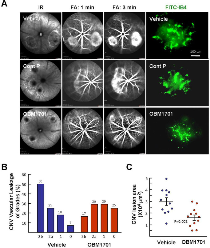 OBM1701 Alleviates Choroidal Neovascularization in Experimental Animals Via Suppressing the Expression of HIF-1α in Retinal Pigment Epithelial Cells.
