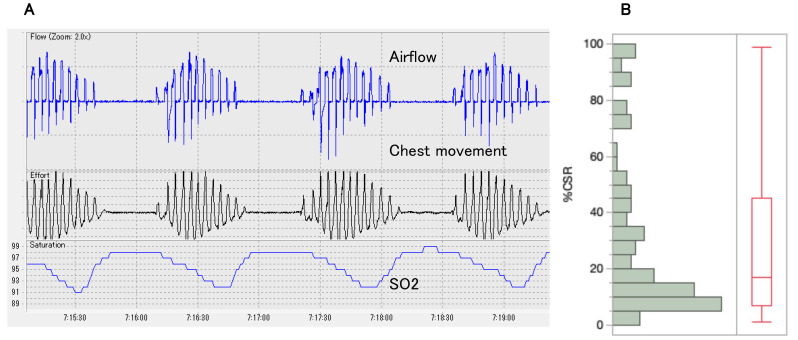 Prevalence of Sleep-Disordered Breathing and Cheyne-Stokes Respiration in Patients With Atrial Fibrillation.