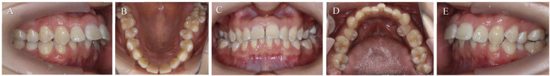 Rescuing a "hopeless" tooth with severe internal resorption during orthodontic therapy: a case report.
