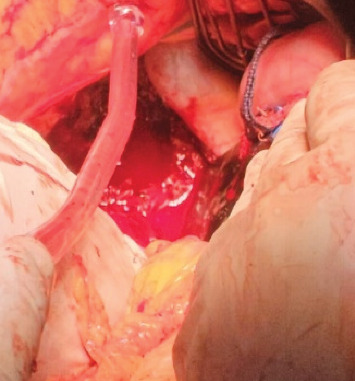 Hemorrhagic Shock in Primary Hepatic Pregnancy: A Diagnostic and Surgical Challenge.