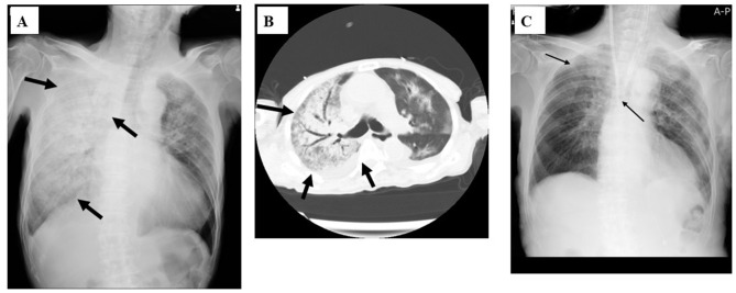 Adult Hospitalized Mycoplasma Cases in a Tertiary Hospital in Japan.