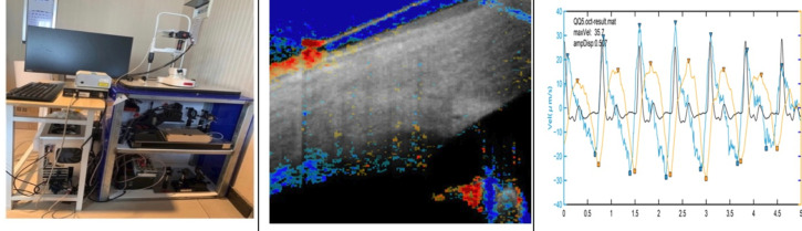 Trabecular meshwork motion reduces in eyes with normal tension glaucoma using phase-sensitive optical coherence tomography.