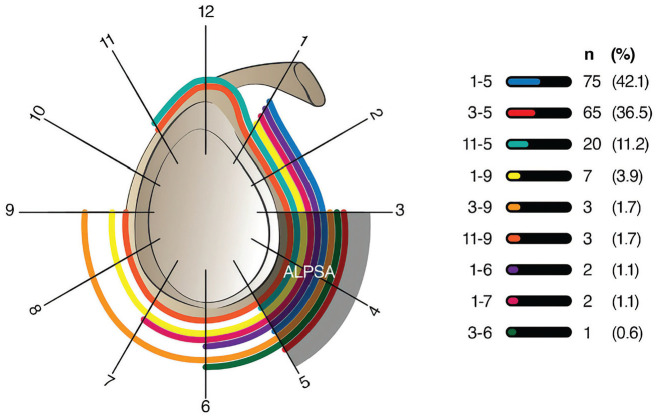 Effect of ALPSA Tear Morphology on Redislocation Risk After Arthroscopic Repair.