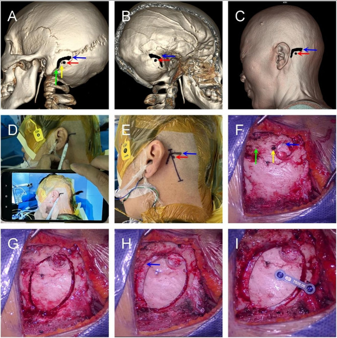 The efficacy of augmented reality technology assisted by 3D-CT reconstruction in microvascular decompression for hemifacial spasm craniotomy.