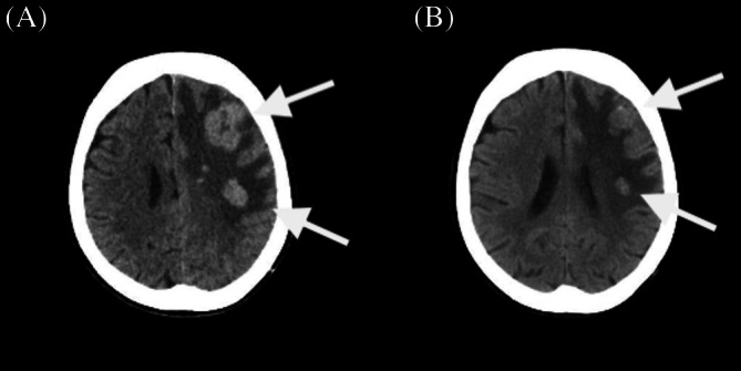 Lorlatinib Achieved Rapid CNS Response in an 81-Year-Old NSCLC Patient With Performance Status Deterioration.