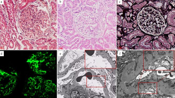 Severe pulmonary arterial hypertension development despite lupus nephritis remission: association with podocytic infolding glomerulopathy.