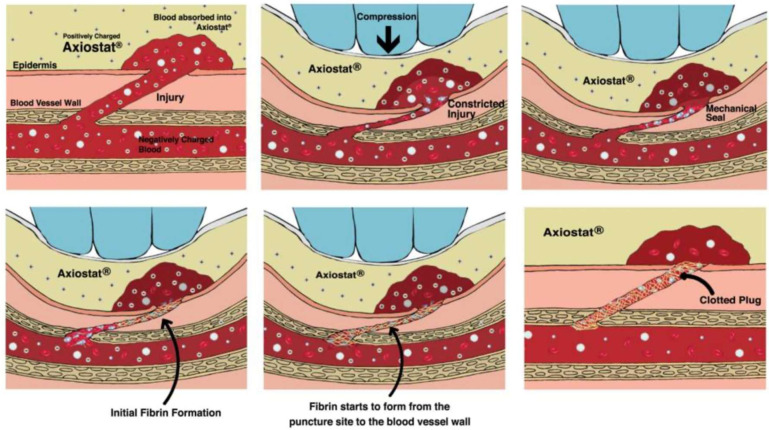Biological Macromolecule-Based Dressings for Combat Wounds: From Collagen to Growth Factors-A Review.