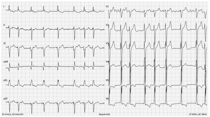 A Case of Success: Guidelines-Based Treatment to Control Atrial Fibrillation-Induced Cardiomyopathy-Atrioventricular Node Ablation and Cardiac Resynchronization Therapy to the Rescue.
