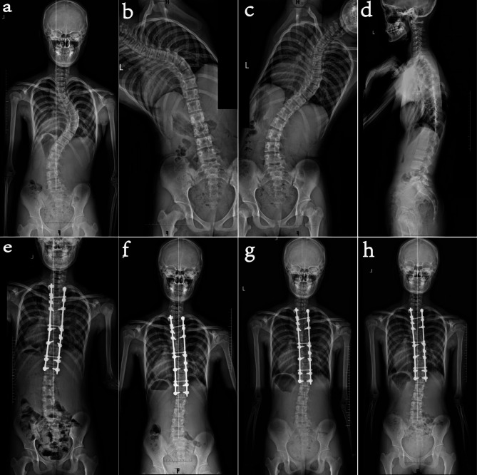 Risk factors for the progression of distal adding-on phenomenon after surgery in patients with Lenke type 1 and 2 adolescent idiopathic scoliosis.