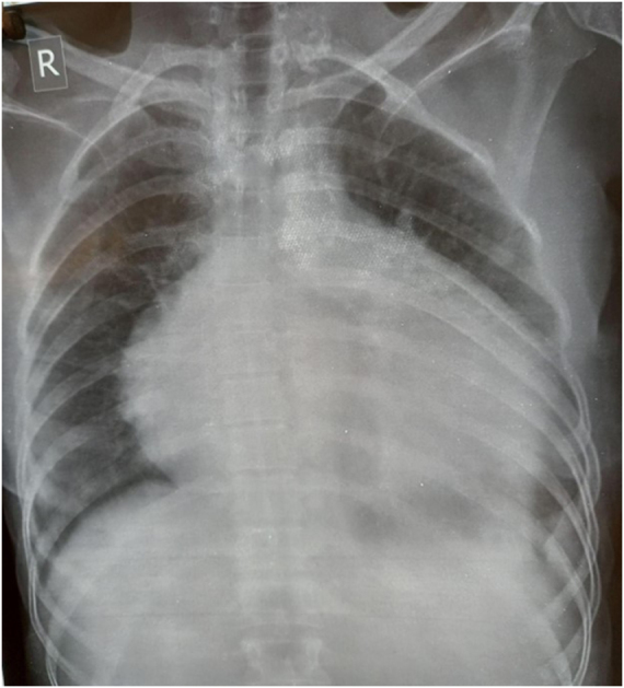 Cardiac tamponade with scleroderma renal crisis in systemic sclerosis: a case report.