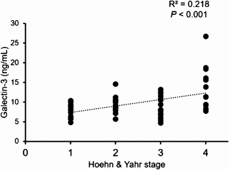 The potential role of serum and urine galectin-3 values in the diagnosis and staging of Parkinson's disease.
