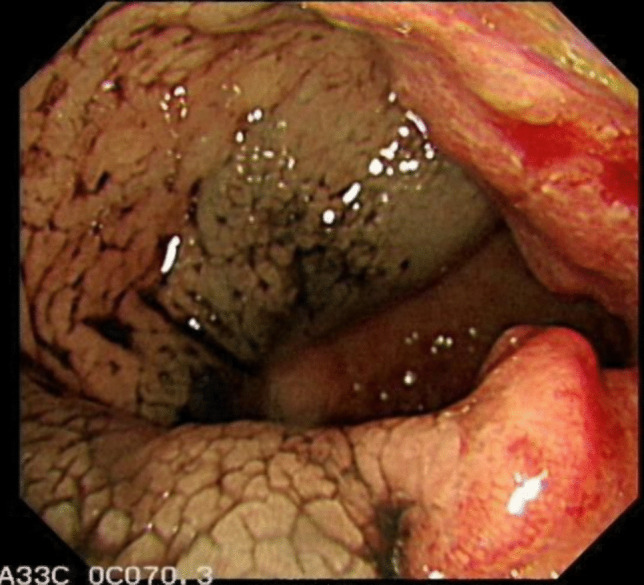 The impact of nano-carbon suspension lymph node tracing on rectal cancer surgery post-neoadjuvant therapy.