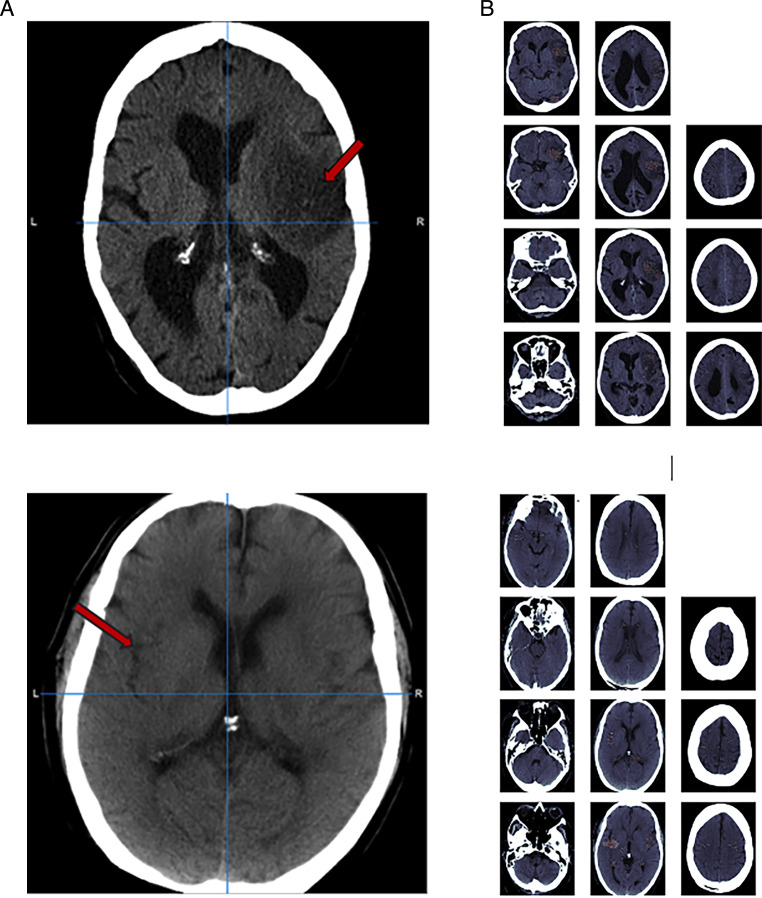 Development of a deep learning method to identify acute ischaemic stroke lesions on brain CT.