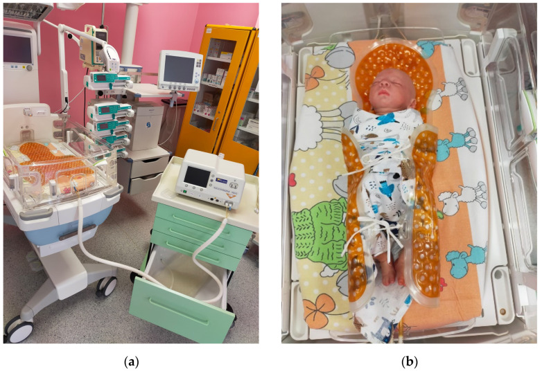 Case Report of a Neonate with Severe Perinatal Asphyxia: A Multidisciplinary Approach Involving Therapeutic Hypothermia and Physiotherapy.