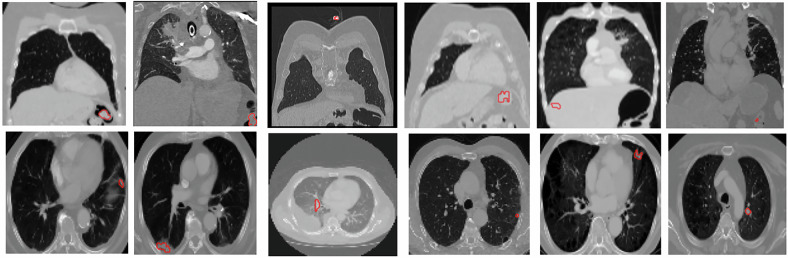Advancing deep learning-based segmentation for multiple lung cancer lesions in real-world multicenter CT scans.