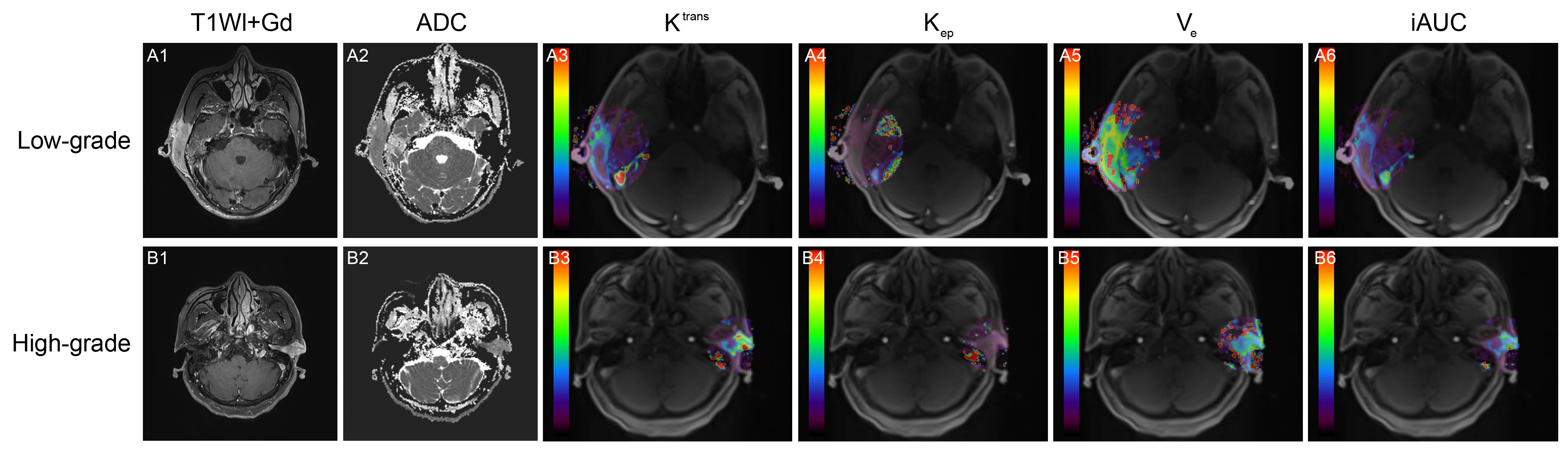 Diagnostic values of diffusion-weighted imaging and dynamic contrast-enhanced MRI in the pathological grading of adenoid cystic carcinoma.