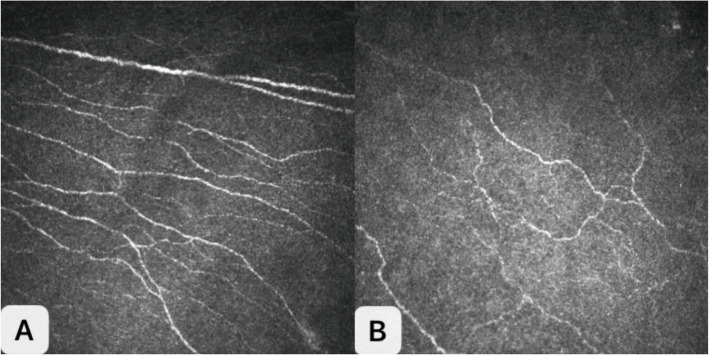 Analysis of the correlation between corneal and meibomian gland morphology and glycated hemoglobin levels in type 2 diabetes patients.