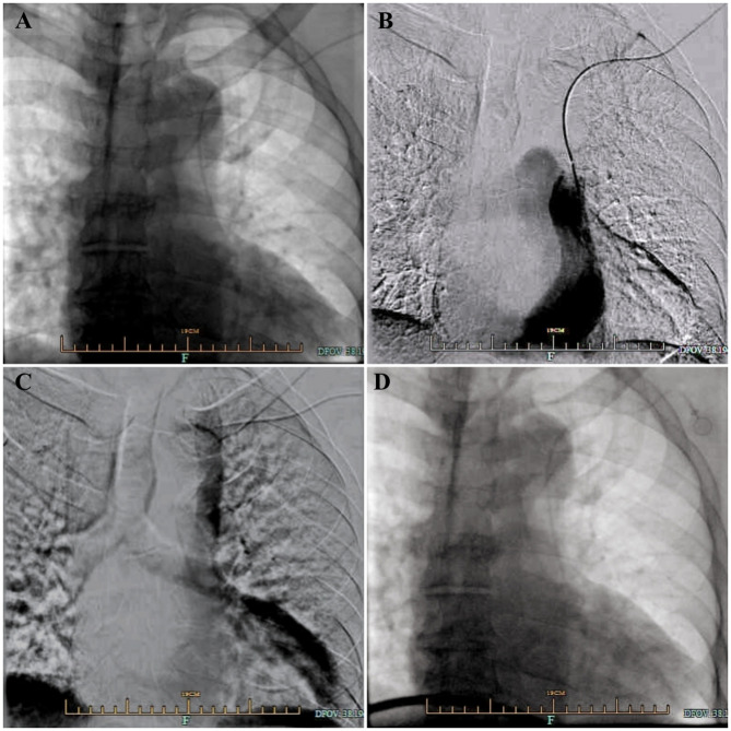 Venous Port implantation in persistent left superior vena cava with azygos vein variation: a case report and literature review.