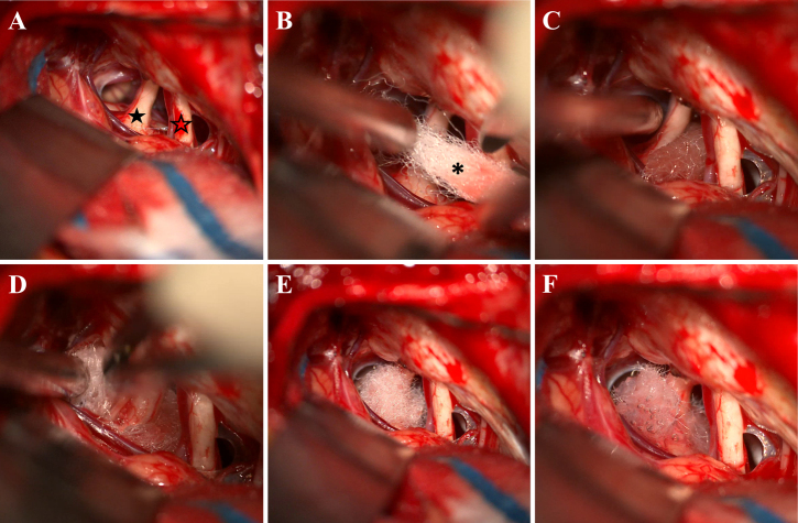 Wrap technique for idiopathic trigeminal neuralgia: patient series.