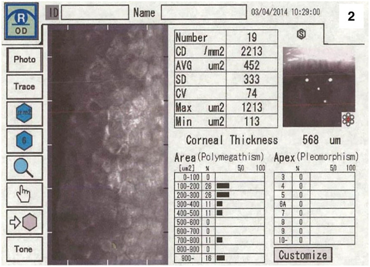 10-Year outcome of descemet stripping only in a patient with Fuchs endothelial dystrophy: a case report.