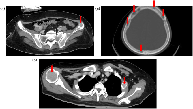 Severe hypercalcemia requiring emergency hemodialysis and multidrug therapy in a case of diffuse large B-cell lymphoma with multiple bone lesions.