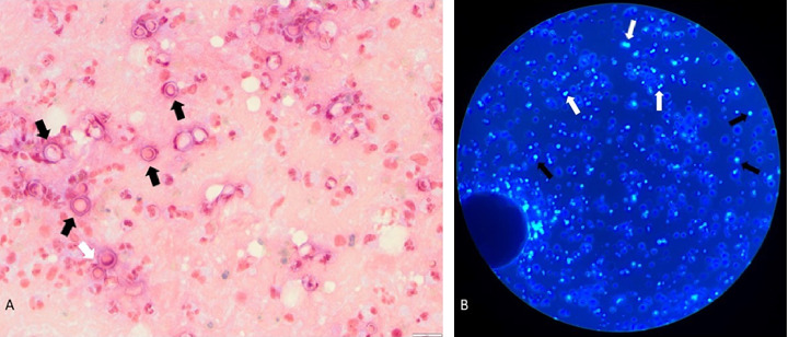 Siblings in the ICU: Keeping Endemic Mycoses on the Differential.