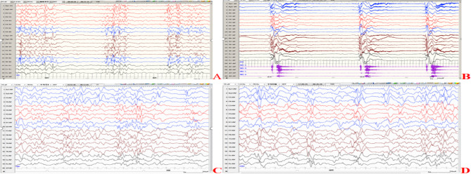 Identification of three novel GNAO1 variants in a Chinese cohort with GNAO1 encephalopathy: expanding the clinical and genetic spectrum.