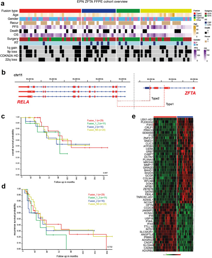 Correction: Biglycan-driven risk stratification in ZFTA-RELA fusion supratentorial ependymomas through transcriptome profiling.