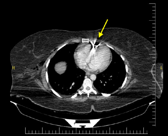 Intracardiac shrapnel fragment after blast injury in a hemodynamically stable patient: a case report from Somalia.
