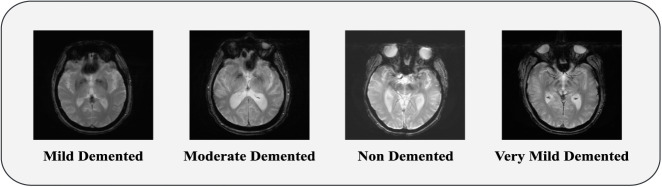 Novel deep learning for multi-class classification of Alzheimer's in disability using MRI datasets.