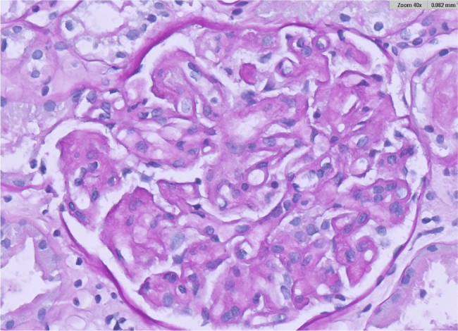 When is A Kidney Biopsy Indicated During the Treatment of Brain Cancer?