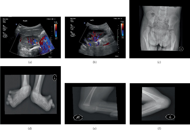 The Intersection of Genitopatellar Syndrome and Oral Health: A Case Report at Saudi Arabia.