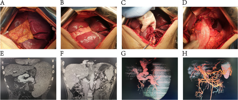 Partial splenectomy and pericardial devascularization for symptomatic patients with portal hypertension: a single-center retrospective study.