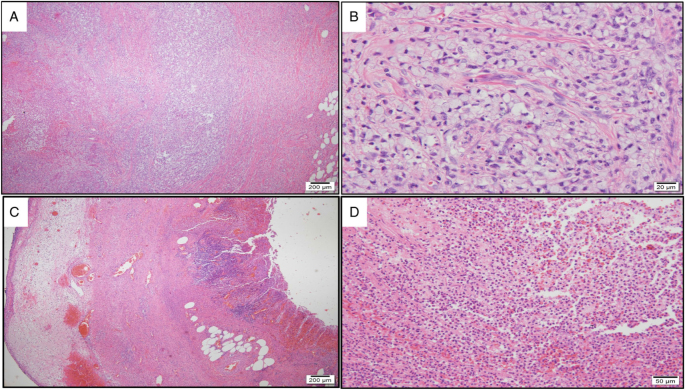 Primary signet ring cell carcinoma of the appendix presenting as gangrenous appendicitis with peritonitis: a case report.