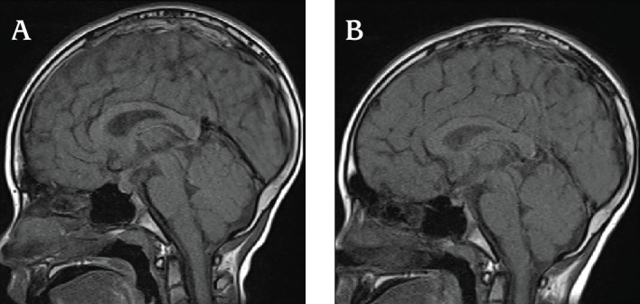 Diagnosis of Lymphocytic Infundibuloneurohypophysitis After Positive Anti-rabphilin-3A Antibody Test in an 8-year-old Boy with Early-onset Central Diabetes Insipidus