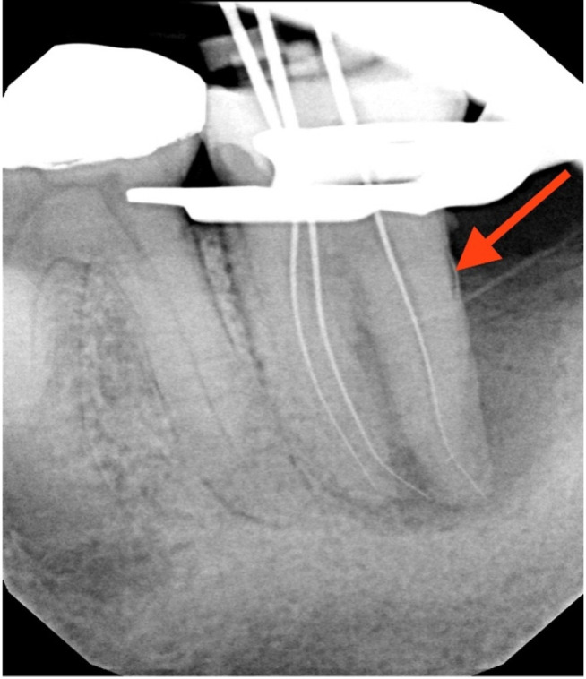 Multidisciplinary management of an endo-perio lesion complicated by a cemental tear: a case report.