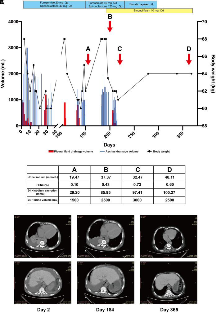 Complete Resolution of Refractory Ascites and Pleural Effusion with Sustained Improvement in Urinary Sodium Excretion in a Cirrhotic Patient Treated with Empagliflozin.