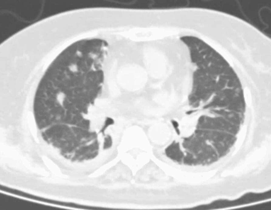 Treatment of liver abscess caused by Klebsiella pneumoniae with multi-site infection: a case report.