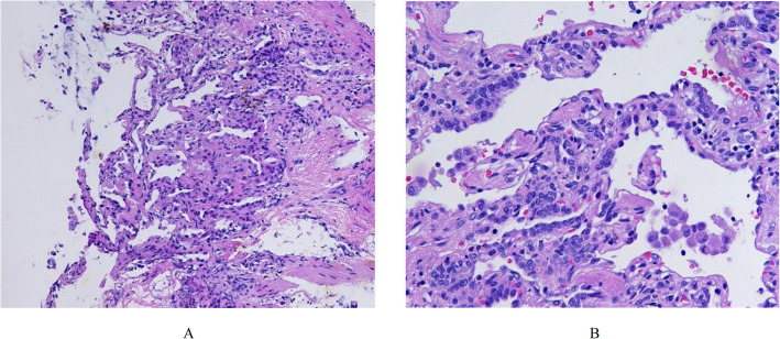 A comparative analysis of clinical phenotypes and outcomes in childhood interstitial lung disease due to surfactant dysfunction disorders: focusing on mutations in SFTPC, ABCA3, and NKX2-1 genes.