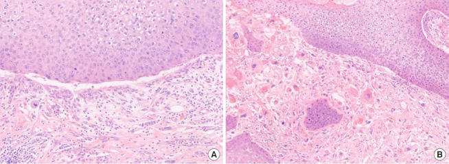 Sarcomatoid squamous cell carcinoma arising in a post-acupuncture keloid scar: a case report and literature review.