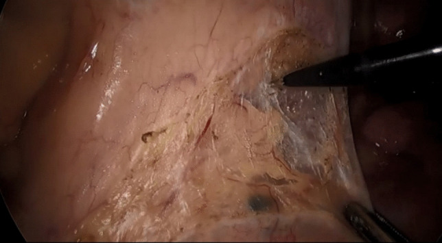 The impact of nano-carbon suspension lymph node tracing on rectal cancer surgery post-neoadjuvant therapy.