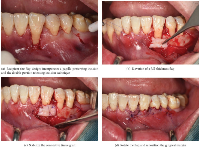 Modified Rotated Flap With Double-Component Releasing Incision and One-Sided Tunnel for Mandibular Gingival Recession: A Case Report.