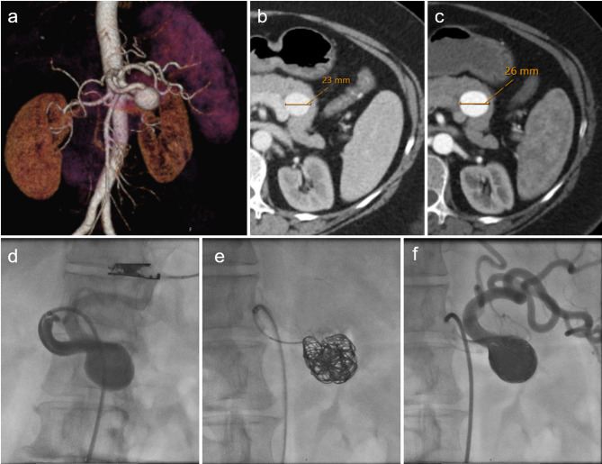 Growth dynamics of splenic artery aneurysms: morphology, comorbidities, and vascular anatomical factors.