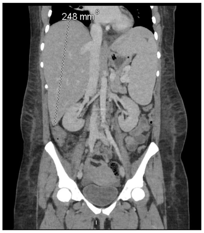 Fatal Cytokine Collision: HLH-AIHA in Advanced AIDS-Case Report and Literature Review.