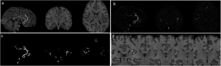 Hippocampal vascular supply and its mediating role in systemic physiological influences on hippocampal volume.