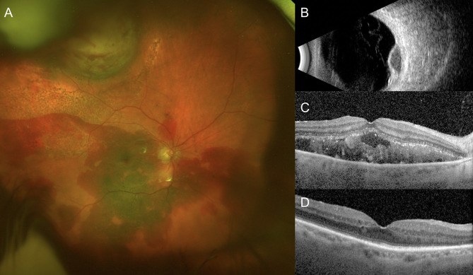 Clinical Characteristics and Treatment Outcomes of Breakthrough Vitreous Hemorrhage in Peripheral Exudative Hemorrhagic Chorioretinopathy (PEHCR).
