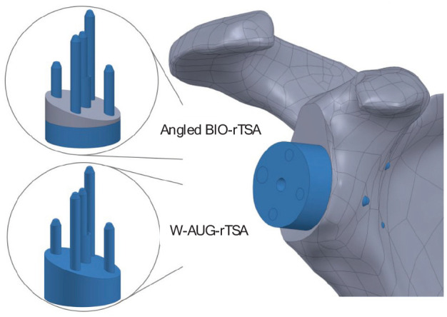 Initial fixation of metallic wedge-augmented versus angled BIO reverse shoulder arthroplasty techniques: A finite element study.