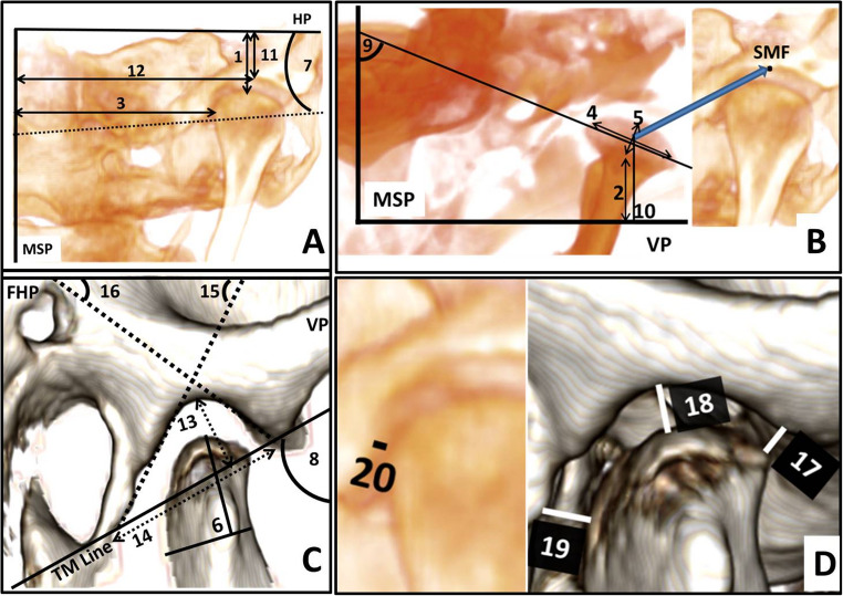 Positional and dimensional temporomandibular joint osseous changes in patients treated with the forsus fatigue resistant device: a non-randomized clinical trial.